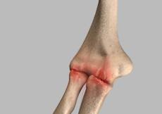 Elbow Arthritis
