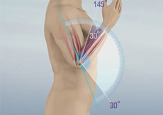 Elbow Contracture (Elbow Stiffness)
