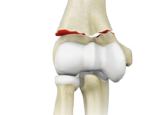 Elbow Fractures