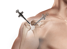 Shoulder Reconstructive Surgery