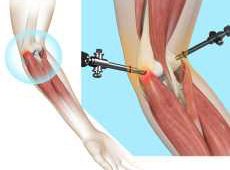 Tennis Elbow Surgery

