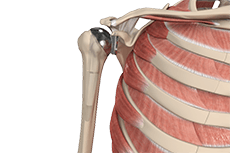 Total Shoulder Replacement (Total Shoulder Arthroplasty)