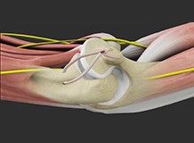 Elbow Reconstructive Surgery

